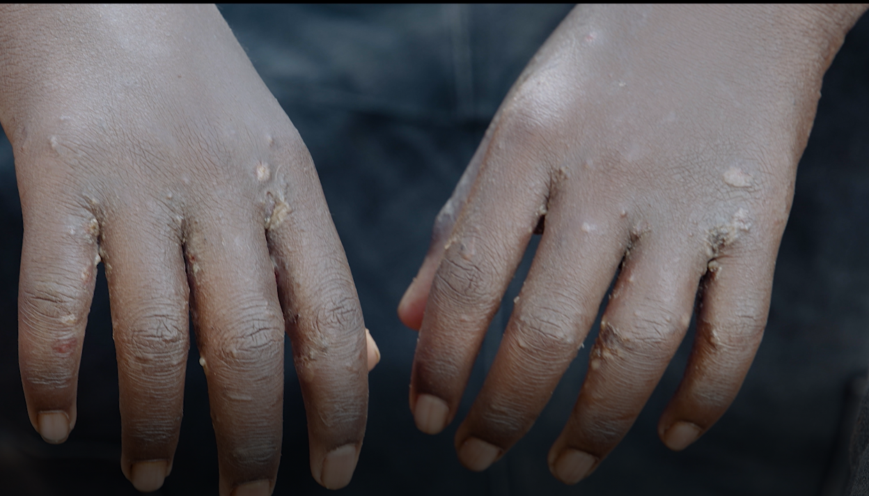 Image of hands of someone with scabes